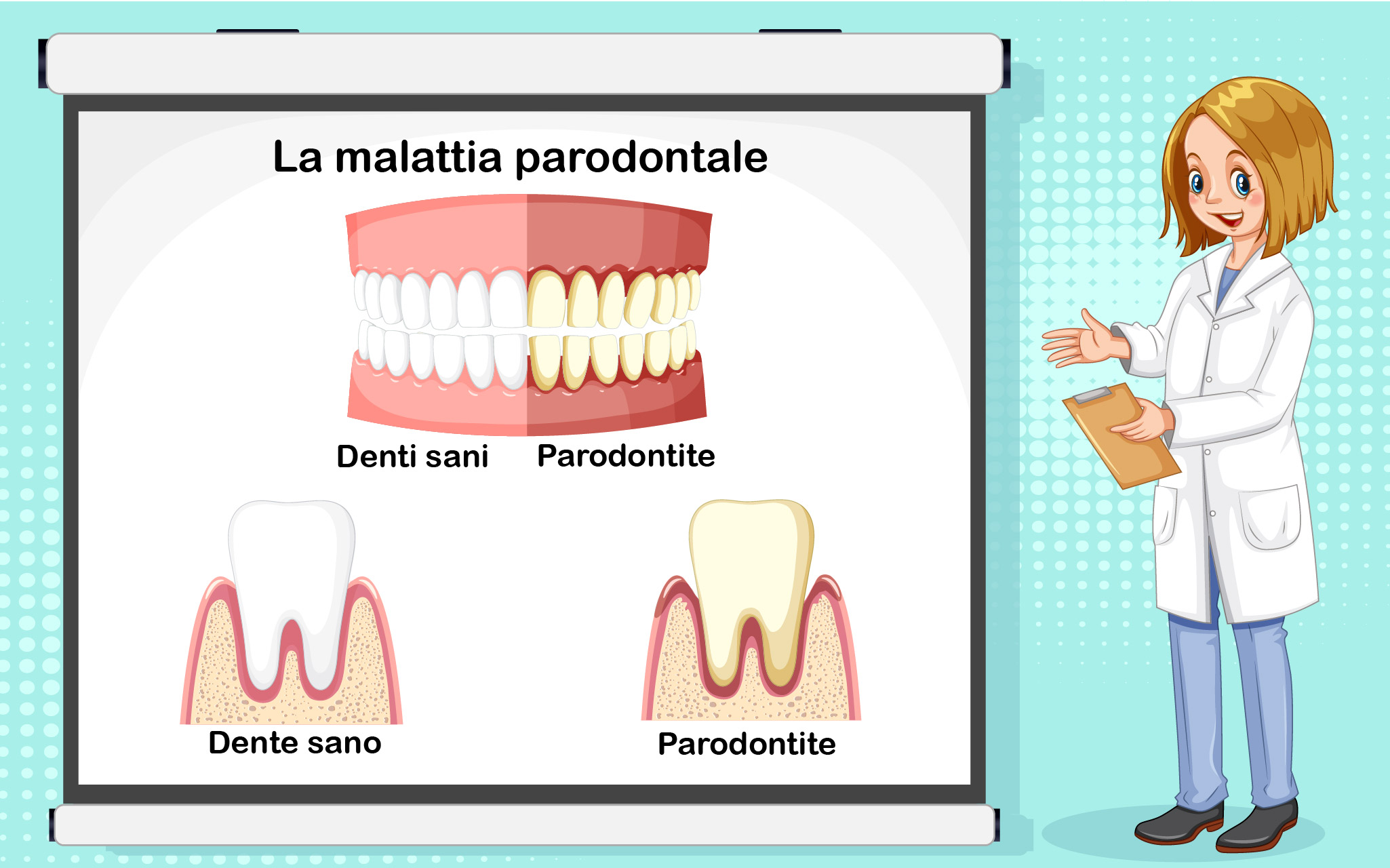 Malattia Parodontale - Parodontite